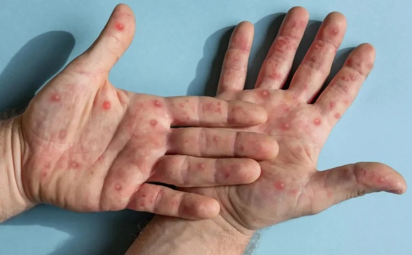 caso-suspeito-de-mpox-foi-registrado-em-campos-e-saude-alerta-para-cuidados