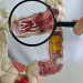 Em 13 anos, doença inflamatória intestinal cresce 5 vezes no Brasil