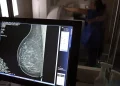 Médicos lançam guia para evitar recusa de mamografia digital
