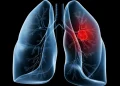 Saiba o que é adenocarcinoma pulmonar, câncer que atinge o Papa Leão