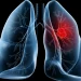 Saiba o que é adenocarcinoma pulmonar, câncer que atinge o Papa Leão